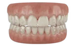 Clear Aligners