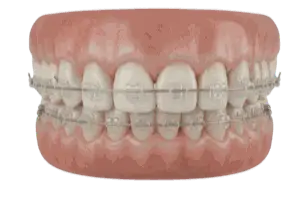 Clear Braces