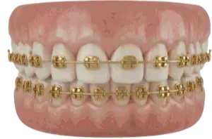 Gold Braces