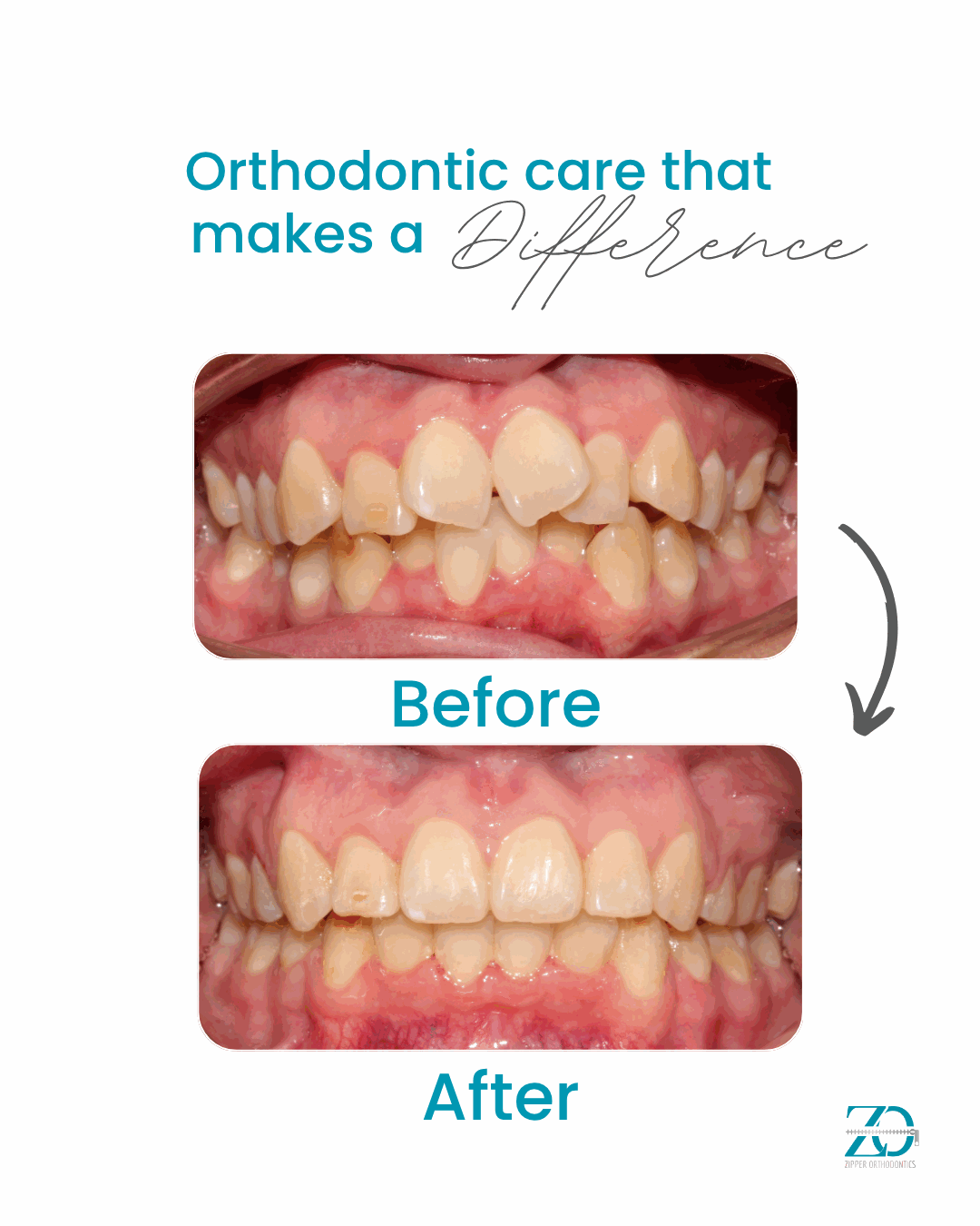 Before and after orthodontic results at Zipper Orthodontics