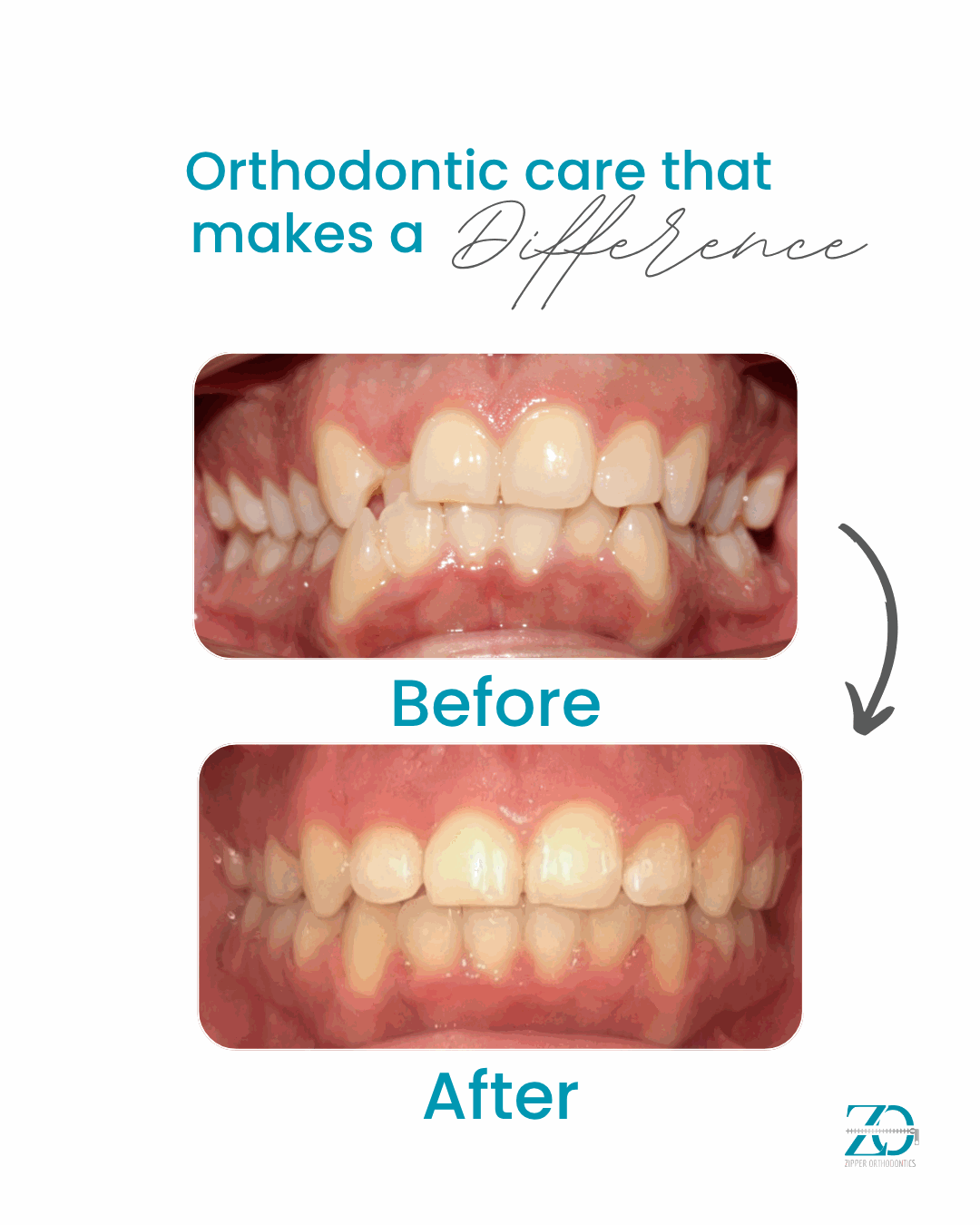 Before and after orthodontic results at Zipper Orthodontics