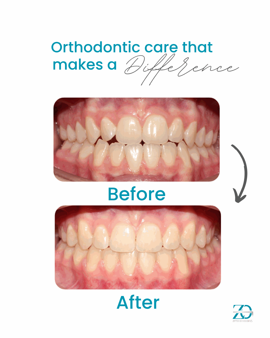 Before and after orthodontic results at Zipper Orthodontics
