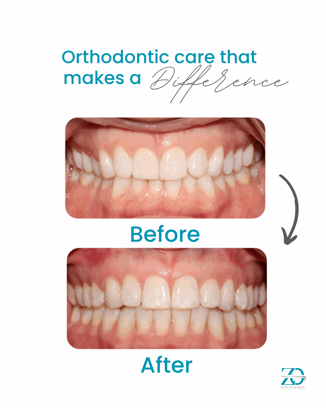 Before and after orthodontic results at Zipper Orthodontics
