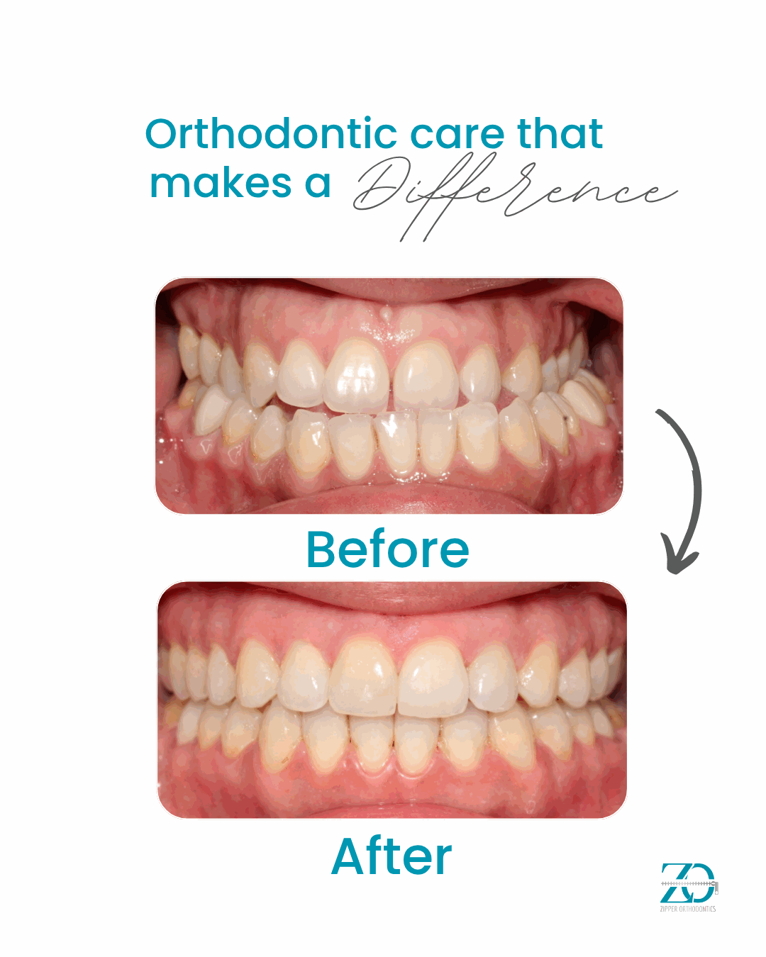 Before and after orthodontic results at Zipper Orthodontics