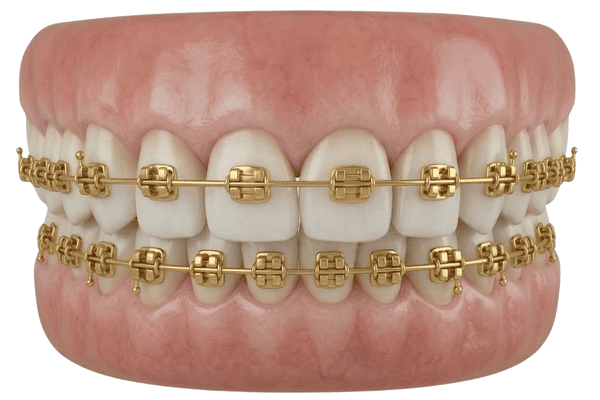 Gold Braces