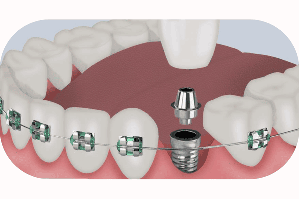 Implant Coordination