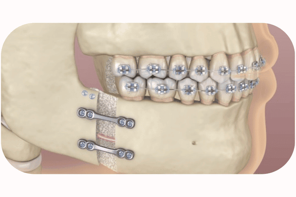 Surgical Orthodontics