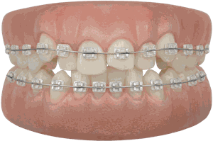 Clear Braces