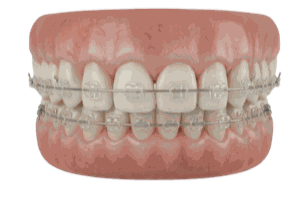 Clear Braces
