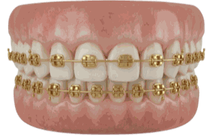 Gold Braces