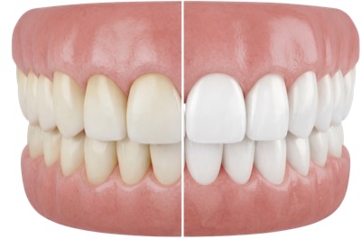 Teeth Whitening
