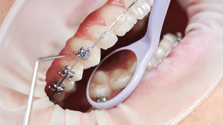 Read more about the article PREPARING FOR BRACES: KEY QUESTIONS TO ASK YOUR ORTHODONTIST