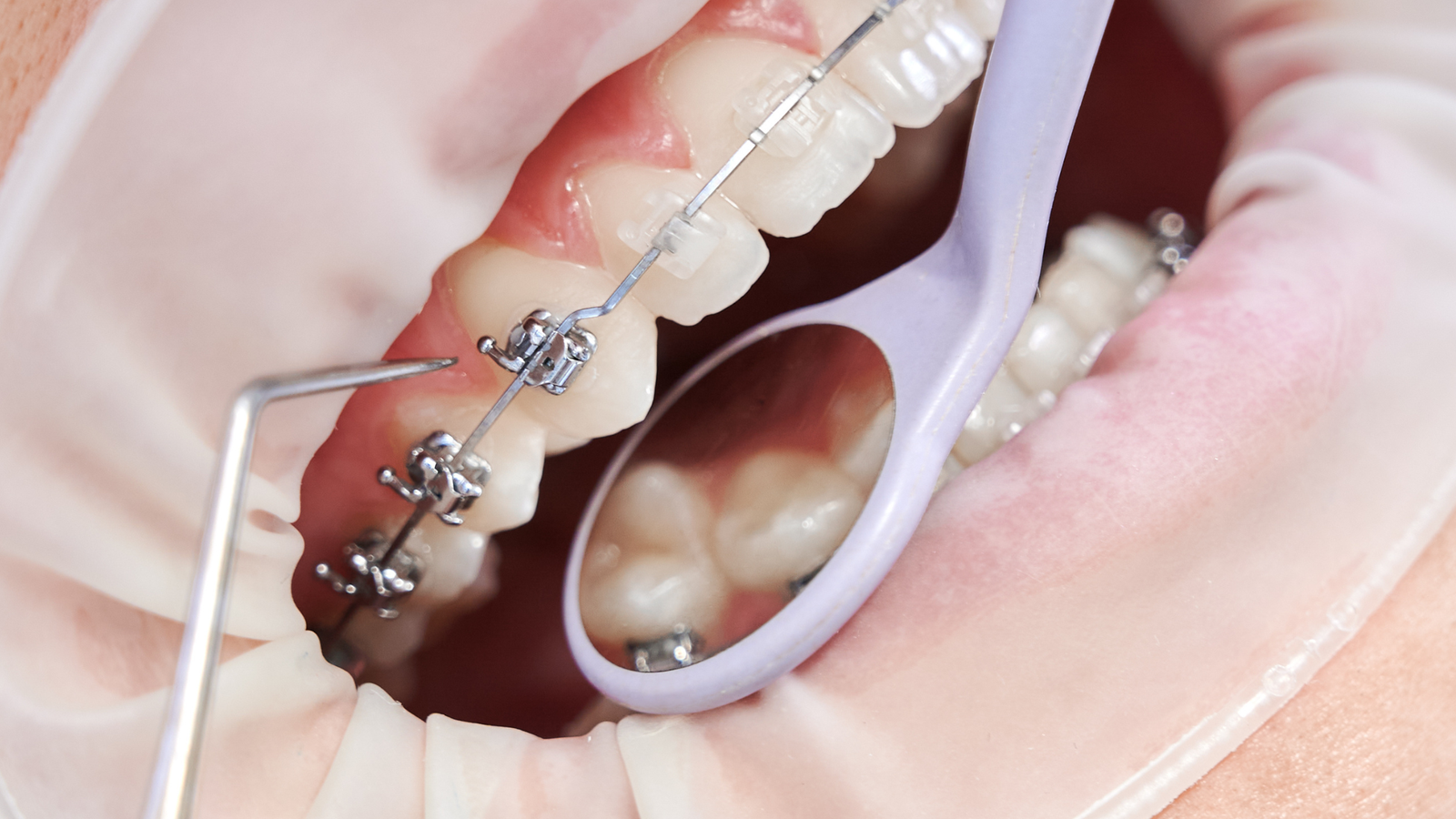 You are currently viewing PREPARING FOR BRACES: KEY QUESTIONS TO ASK YOUR ORTHODONTIST