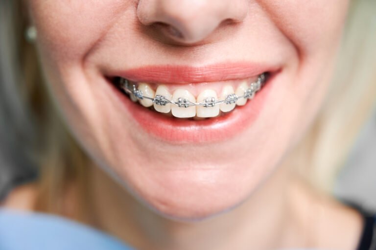 Read more about the article PREVENTING WHITE SPOTS ON TEETH DURING BRACES TREATMENT