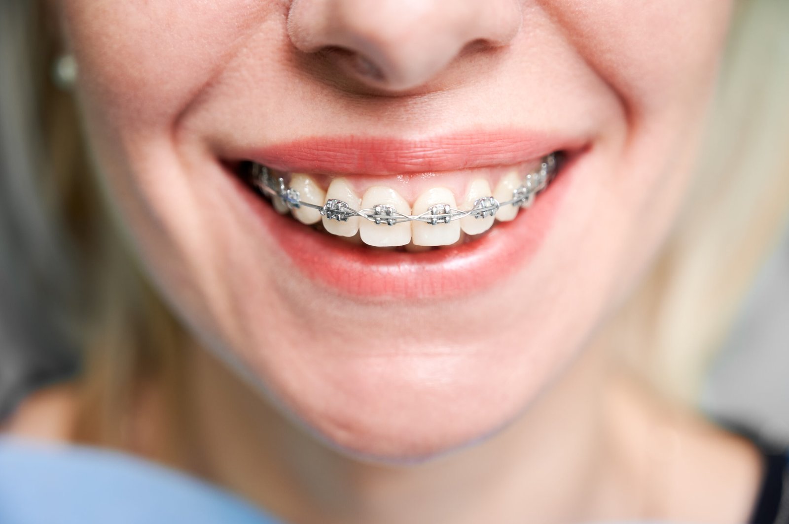 You are currently viewing PREVENTING WHITE SPOTS ON TEETH DURING BRACES TREATMENT