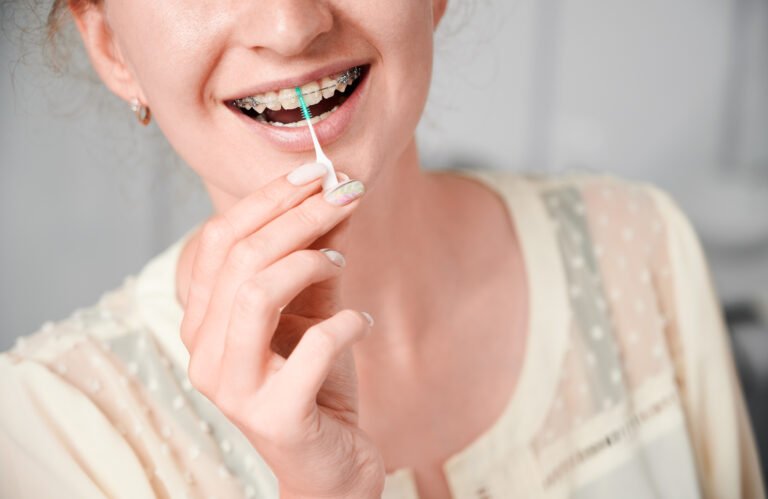 Read more about the article Oral Care With Braces: Tips for Metal and Ceramic Braces